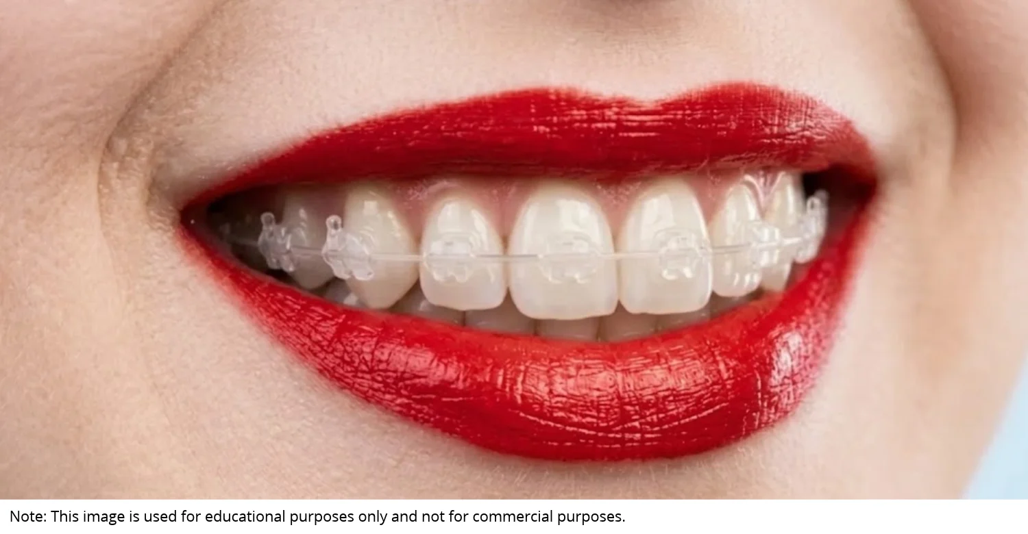 clear braces inblog
